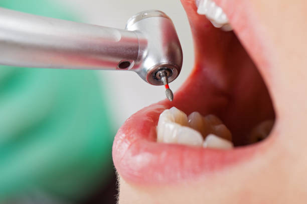 Best Emergency Dental Care for Abscessed Tooth in Santa Barbara, CA